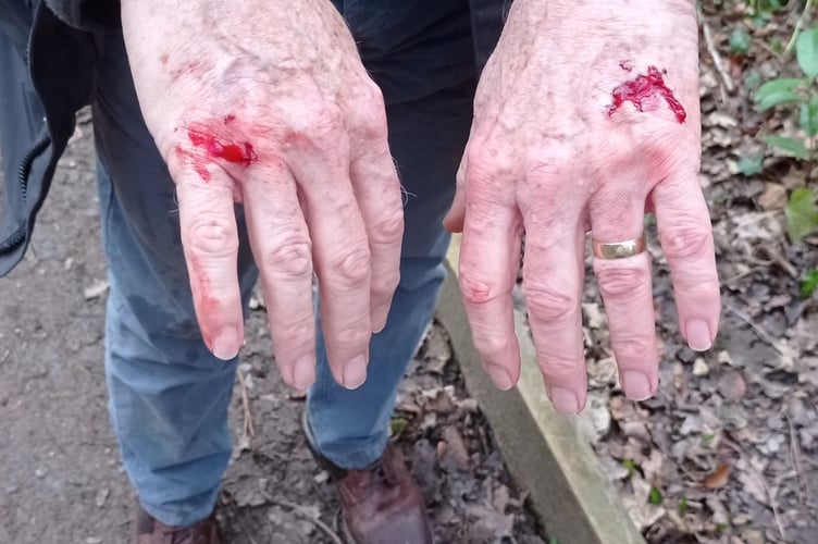 John suffered cuts to both of his hands