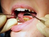 More than two in five people in Devon struggle to get an NHS dentist appointment